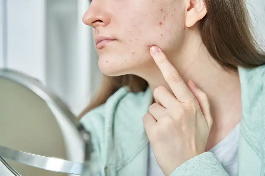 Dermatologist acne treatment consultation at aesthetic clinic in Jumeirah 3 Dubai