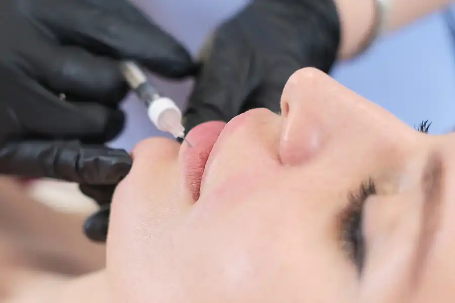 Hyaluronic acid lip contouring injection administered at Jumeirah clinic.